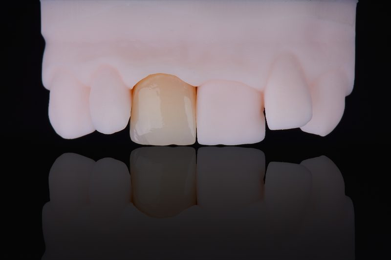 Layered zirconia crown — premium aesthetic dental lab